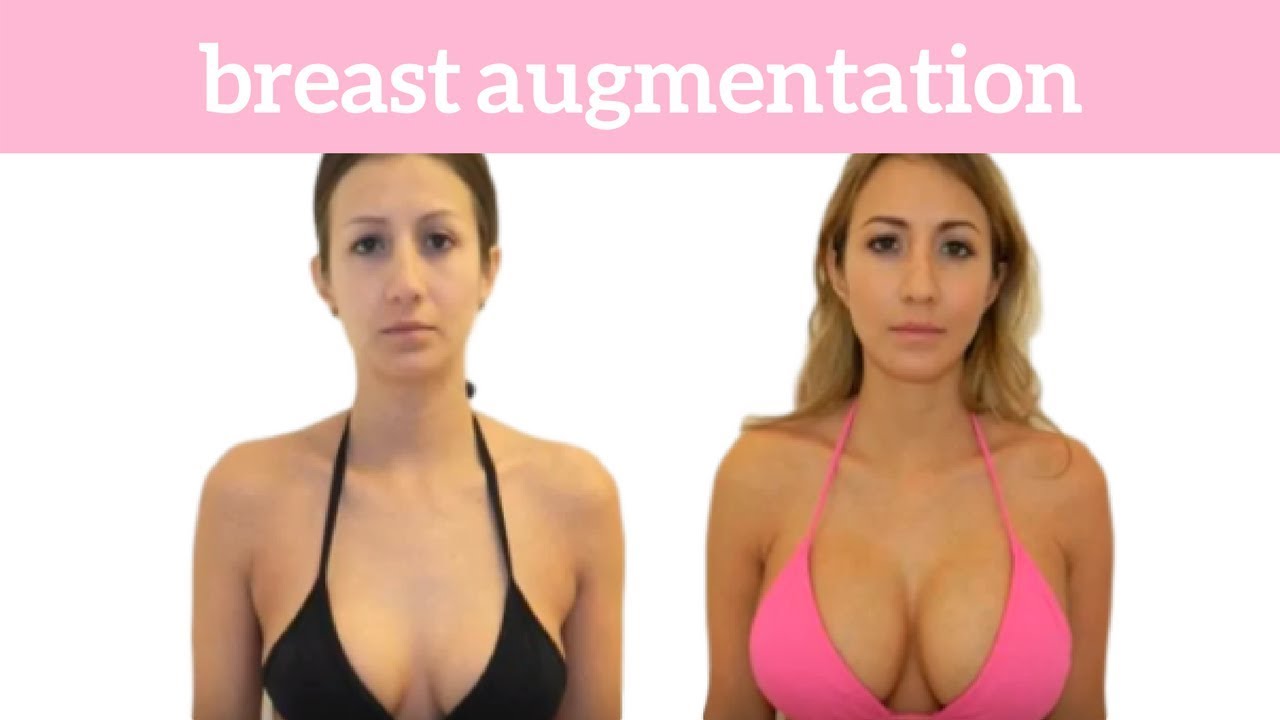 Breast augmentation in nagpur