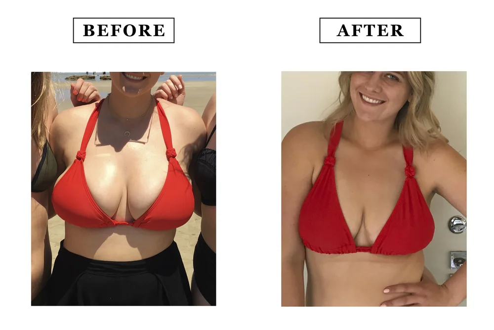Breast reduction surgery in nagpur