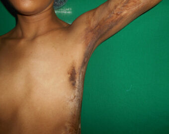 Burn injury reconstruction in nagpur