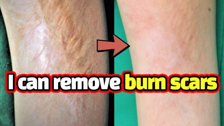 Burn scar treatment in nagpur
