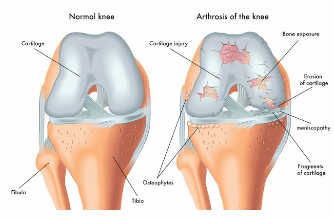 Cartilage Injury Treatment In Nagpur