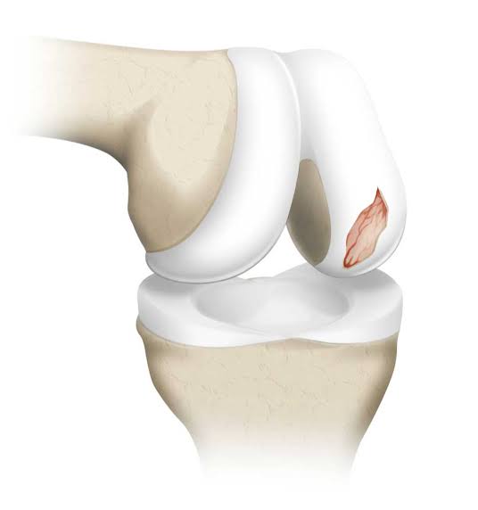 Cartilage damage treatment in Nagpur