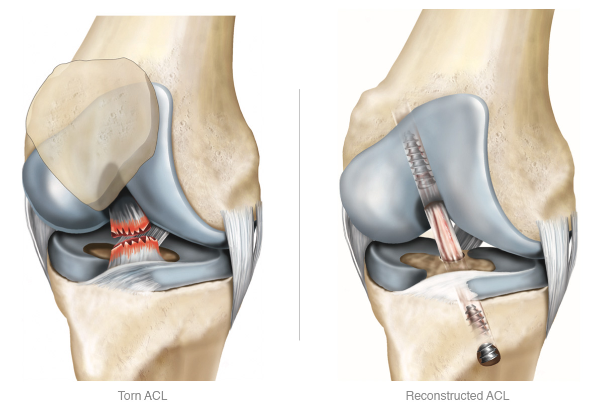 Cruciate Ligament Repair And Reconstruction In Nagpur