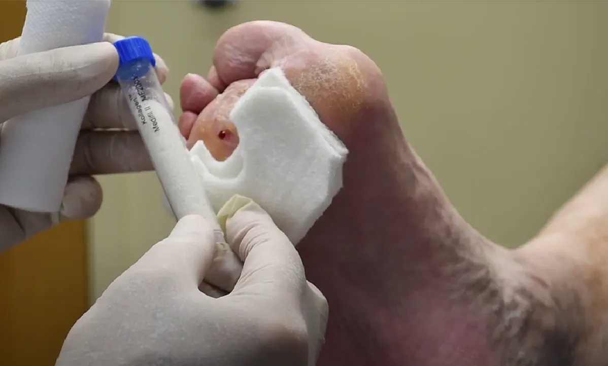 Diabetic Wound Care In Nagpur