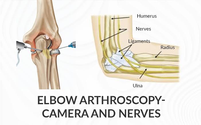 Elbow Arthroscopy in Nagpur