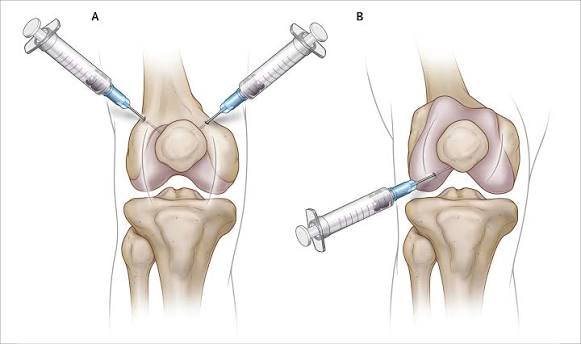 Enhanced joint function outcomes in Nagpur
