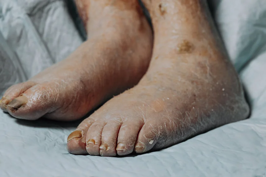 Foot ulcer management in nagpur