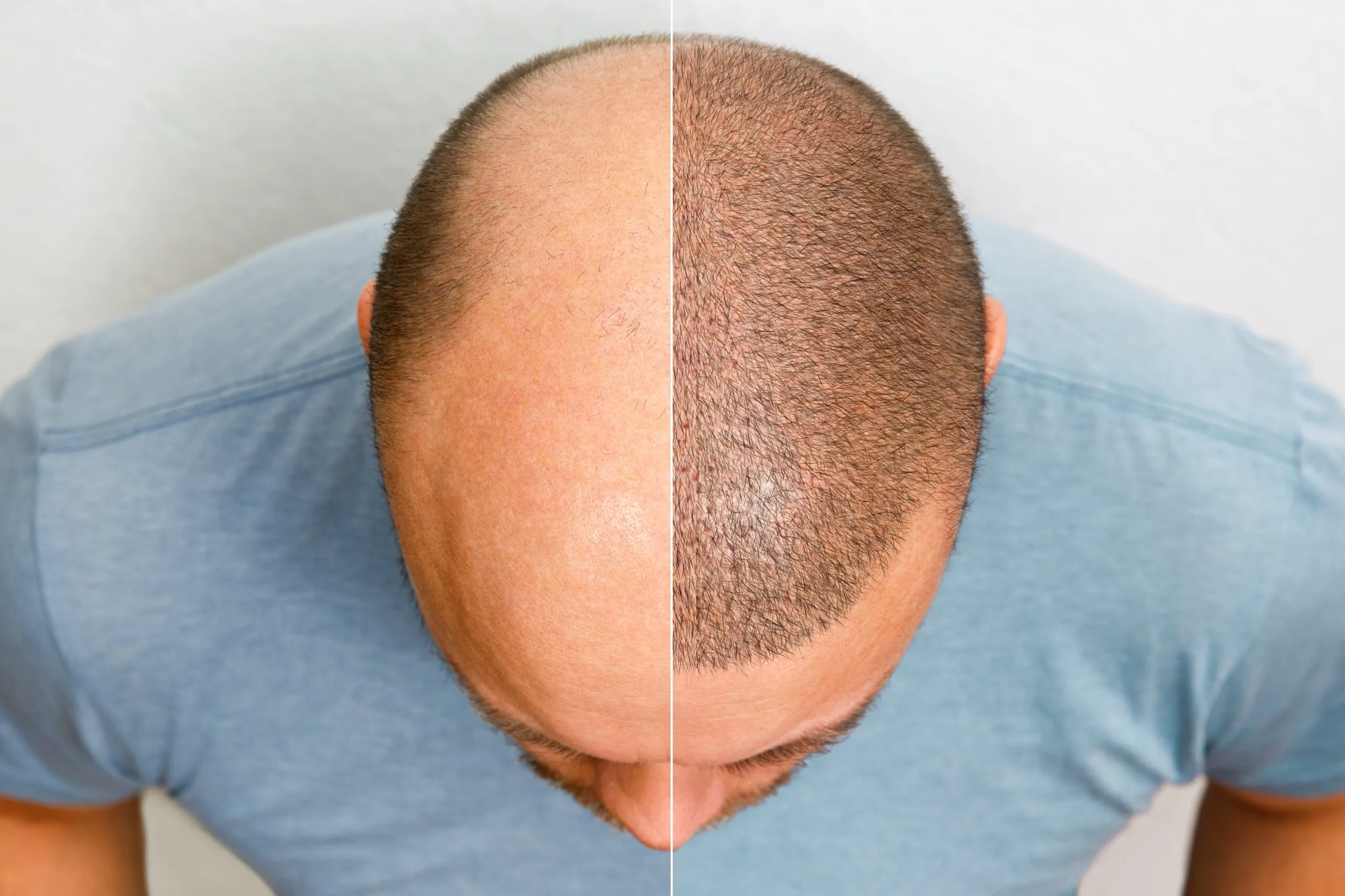 Hair transplant in nagpur