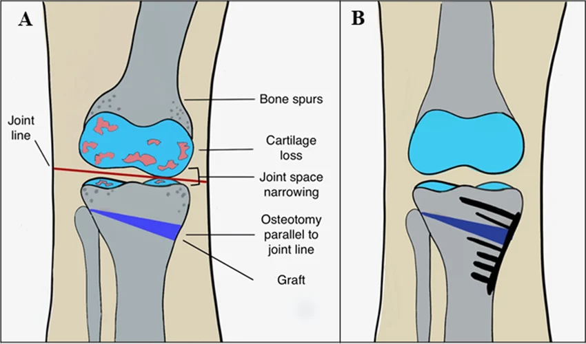 High Tibial Osteotomy (Hto) In Nagpur