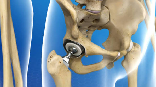 Hip Replacement Surgeon In Nagpur