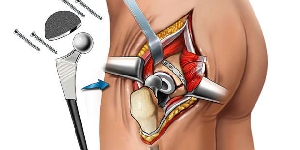 Hip Surgeon In Nagpur