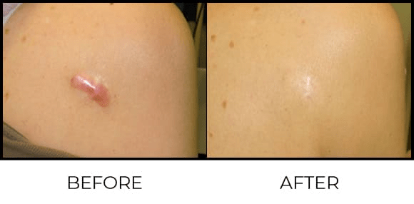 Keloid treatment in nagpur
