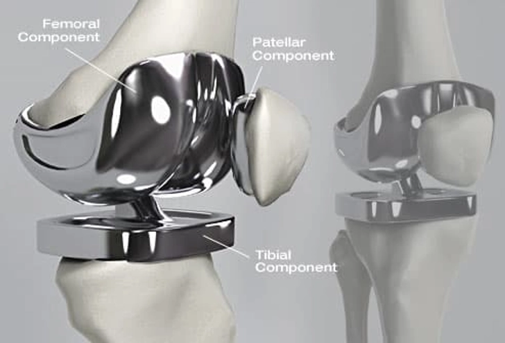Knee Replacement Surgeon In Nagpur