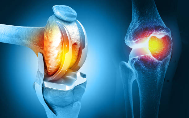 Knee replacement surgery in Nagpur