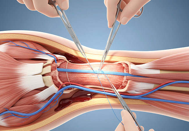 Ligament And Tendon Repair In Nagpur