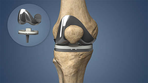 Localized knee joint repair in Nagpur