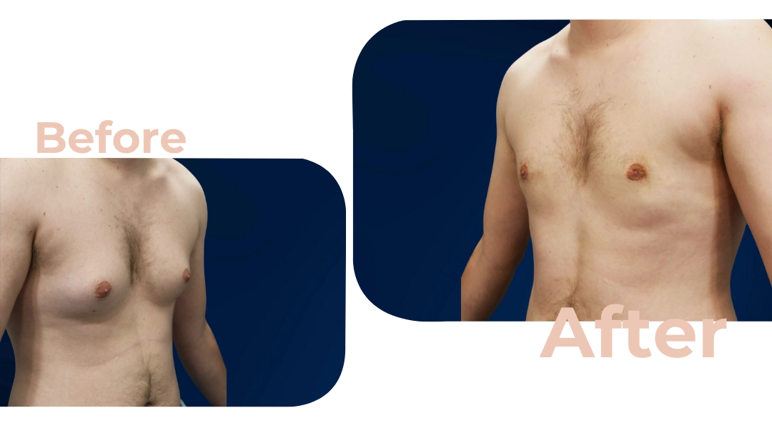 Male breast reduction in nagpur