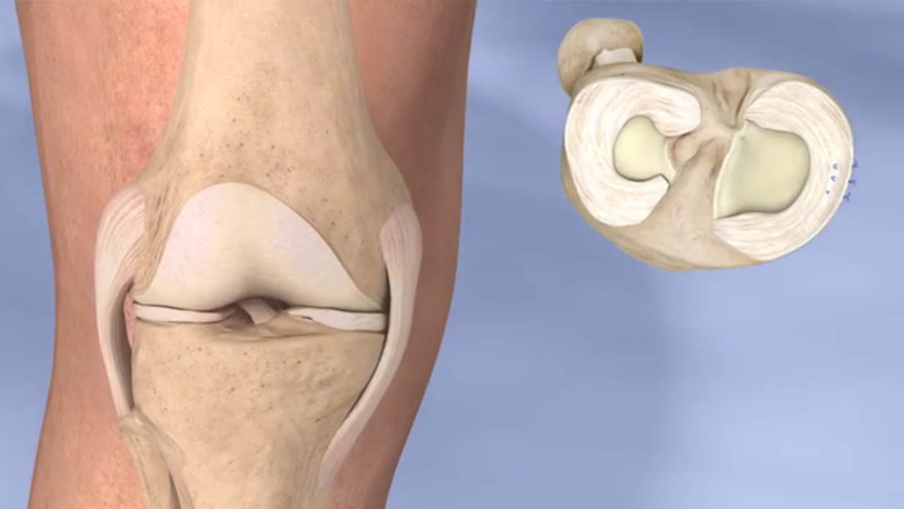 Meniscus Tear Repair In Nagpur