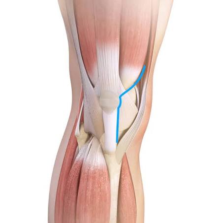 Muscle-sparing joint replacement in Nagpur