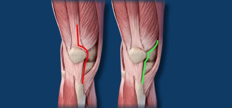 Muscle-sparing knee procedure in Nagpur