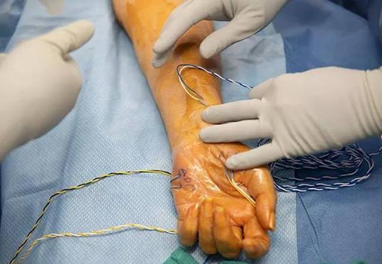 Nerve injury repair in nagpur