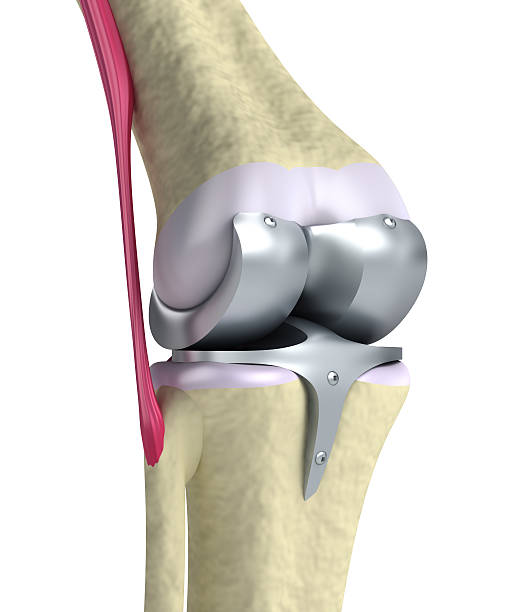 Next-gen joint replacement in Nagpur