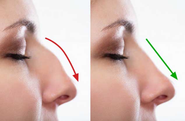 Nose reshaping surgery in nagpur