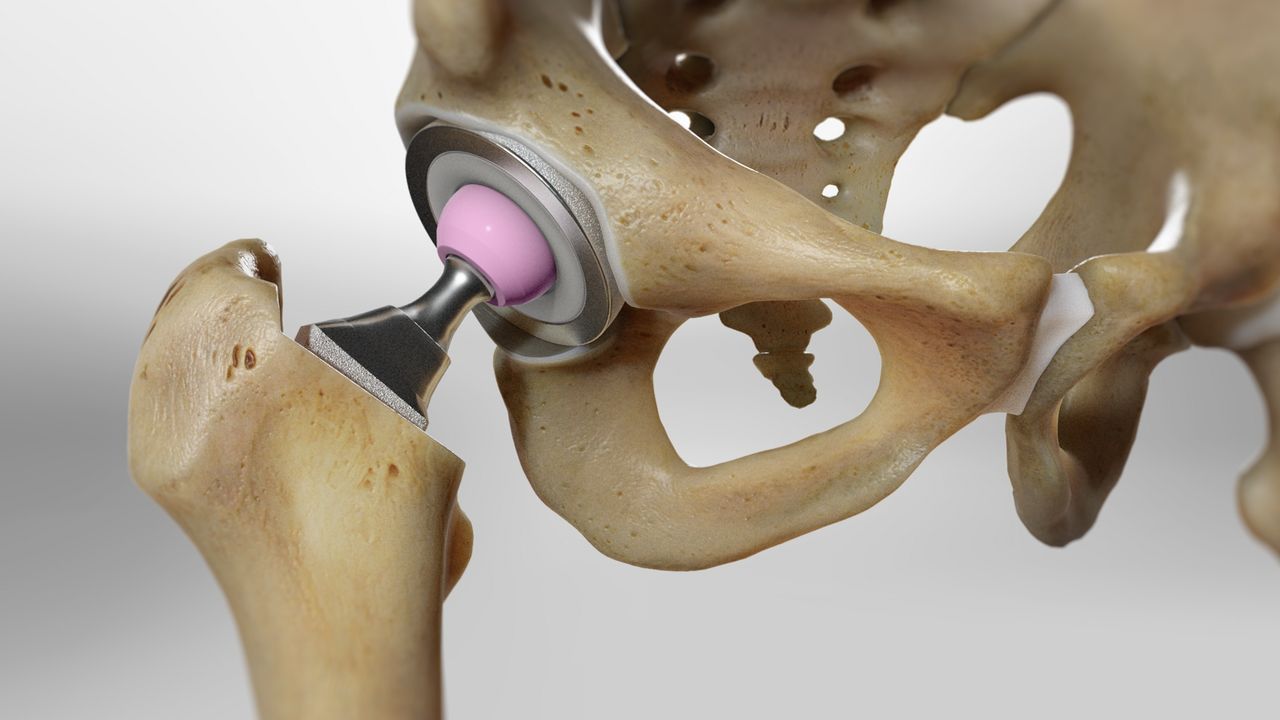 Outpatient hip replacement in Nagpur