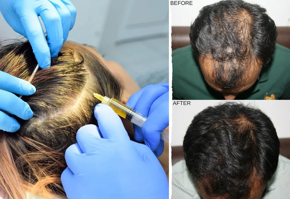 PRP Hair treatment in nagpur