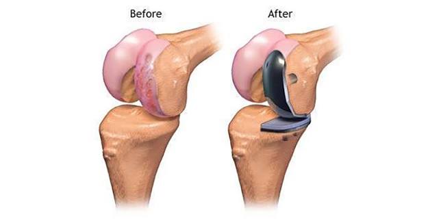 Partial knee replacement in Nagpur