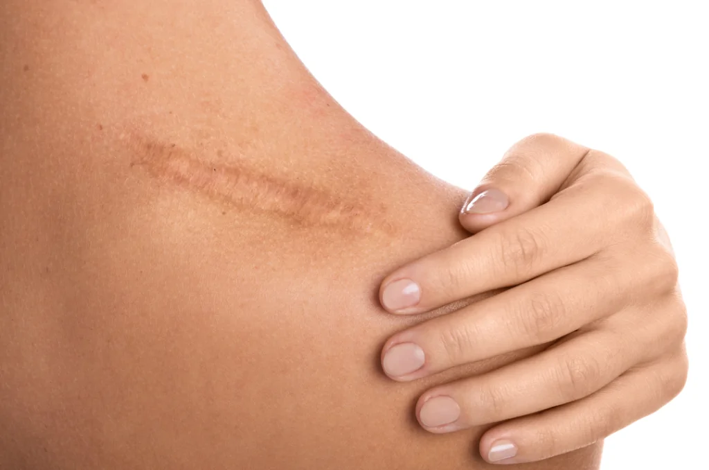 Post surgical scar treatment in nagpur