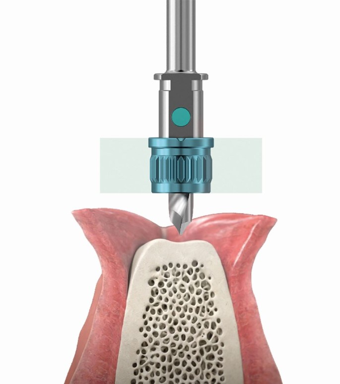 Precision implant alignment in Nagpur
