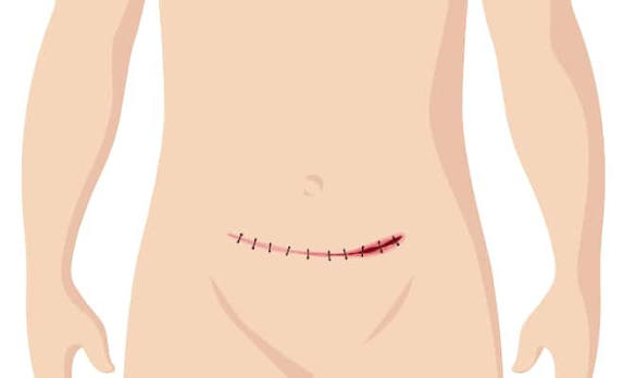 Reduced post-surgical complications in Nagpur