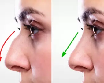 Rhinoplasty in nagpur