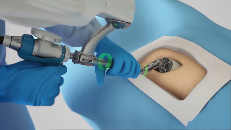 Robotic hip replacement in Nagpur