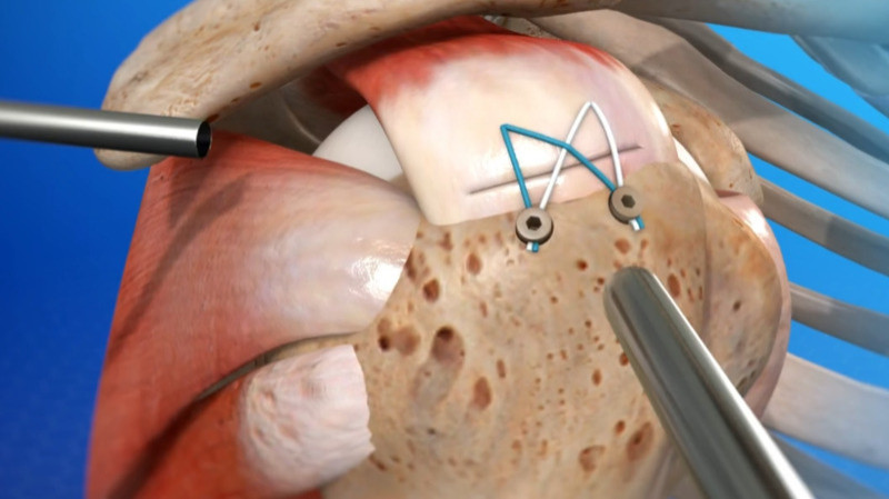 Rotator Cuff Surgeon In Balaghat