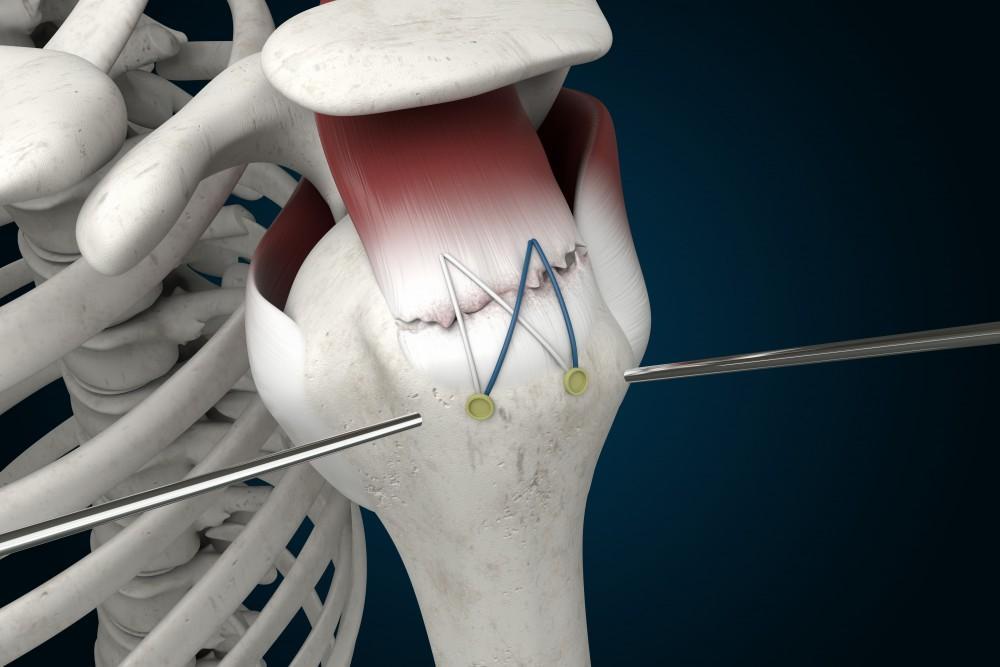 Rotator Cuff Surgeon In Chhindwara