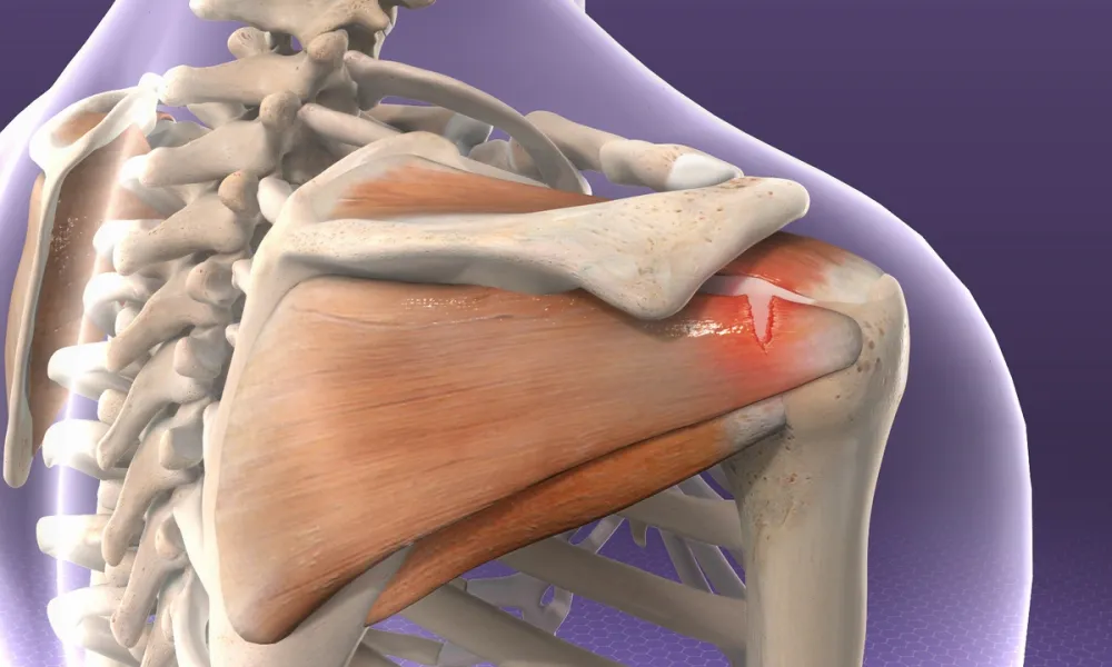 Rotator Cuff Surgeon In Gondia