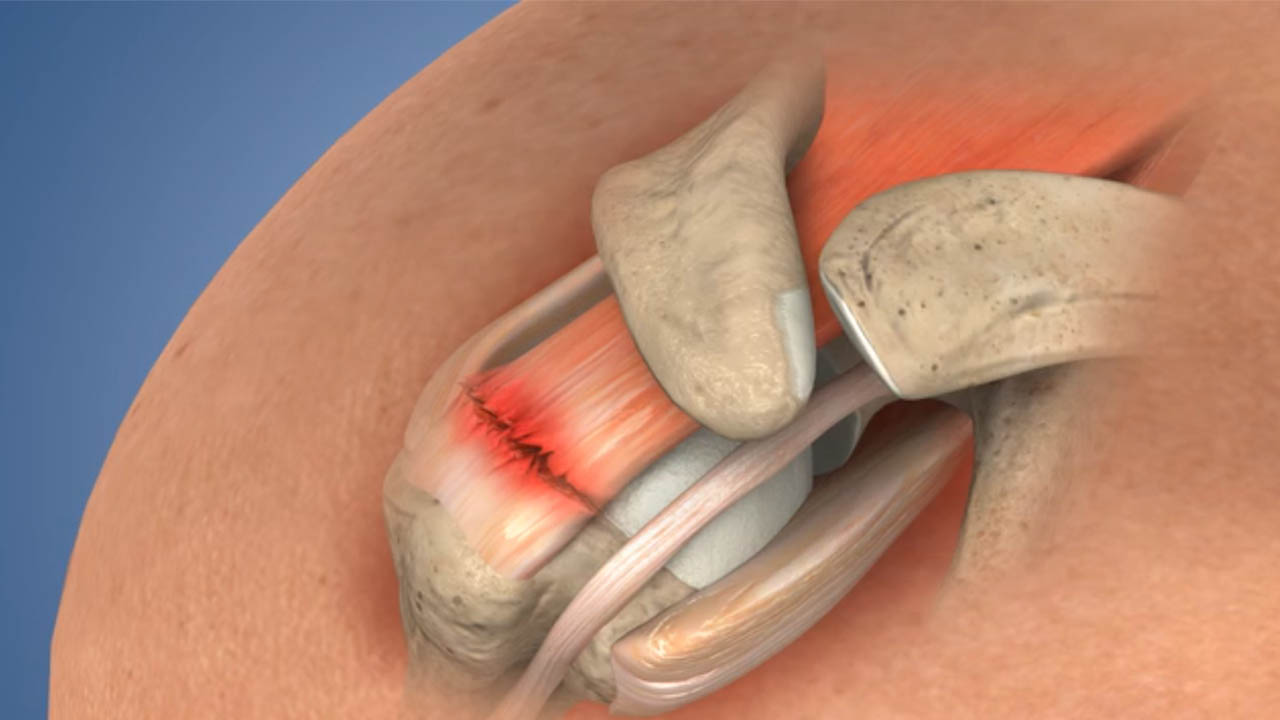 Rotator Cuff Surgeon In Sagar