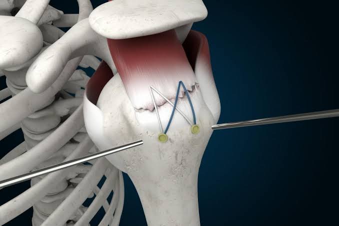 Rotator Cuff Surgeon In Seoni