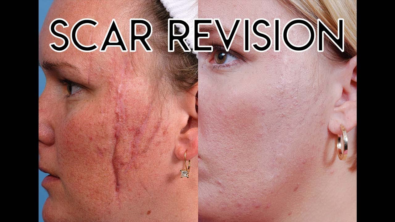 Scar revision surgery in nagpur