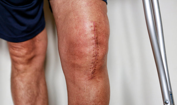 Selective knee replacement procedure in Nagpur