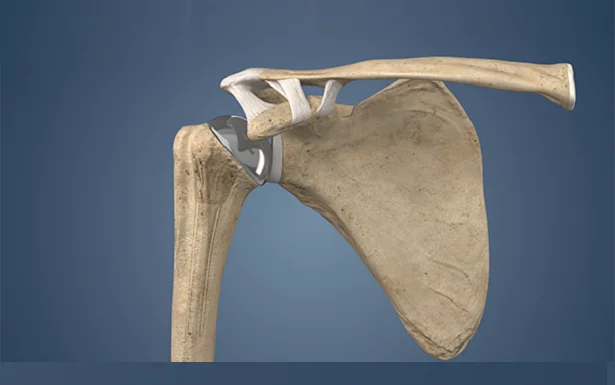 Shoulder Replacement Surgeon In Nagpur
