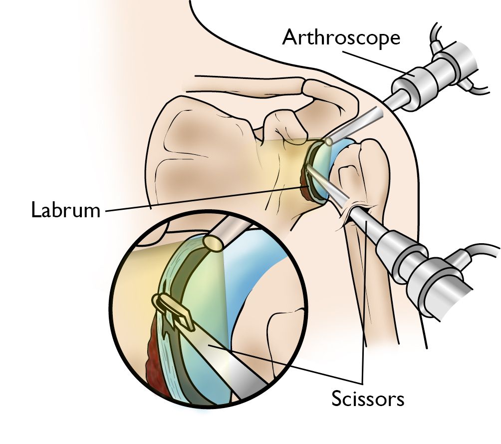 Shoulder labrum tear repair in Nagpur