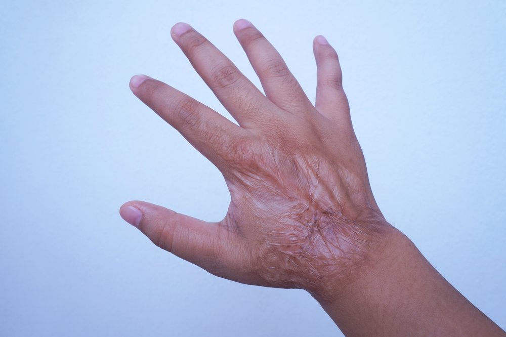 Skin grafting in nagpur