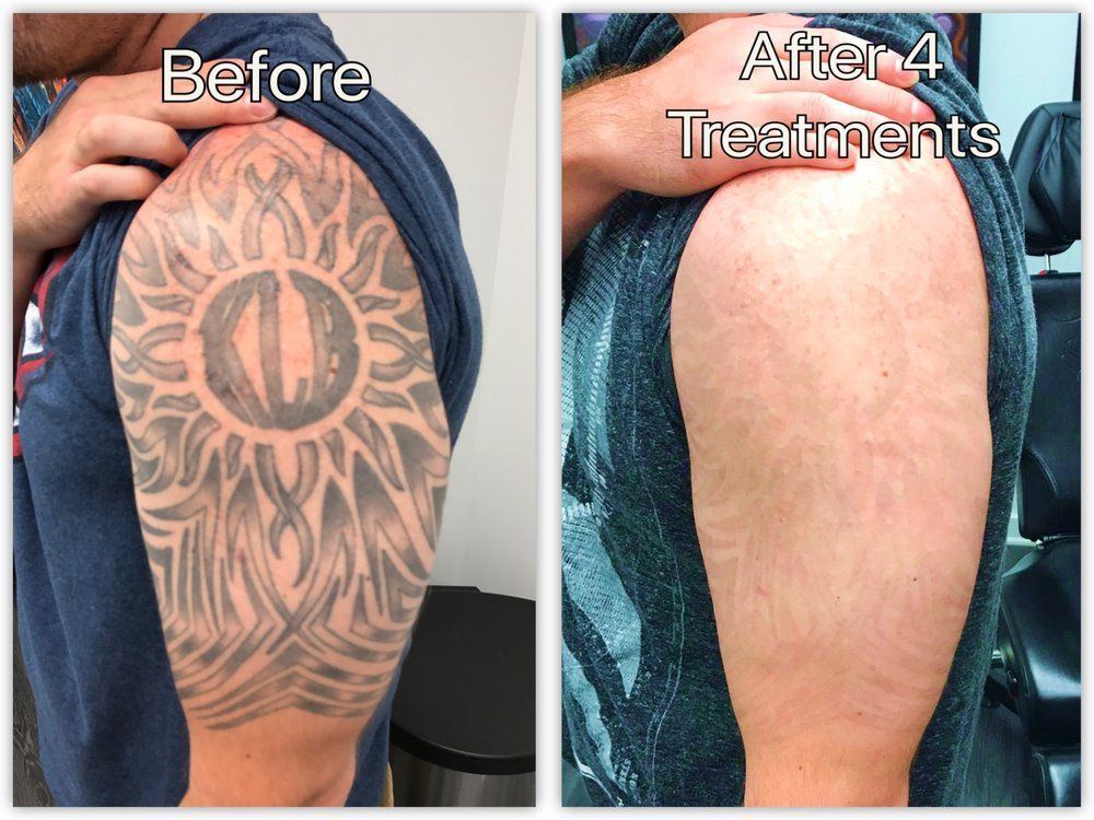 Tattoo removal treatment in nagpur