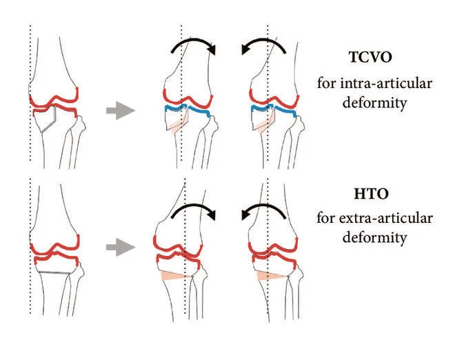 Tibial Condylar Valgus Osteotomy (Tcvo) In Nagpur