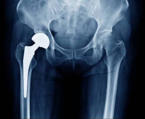 Total hip replacement in Nagpur