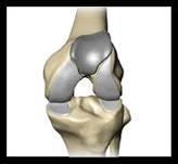 Unicompartmental knee surgery in Nagpur