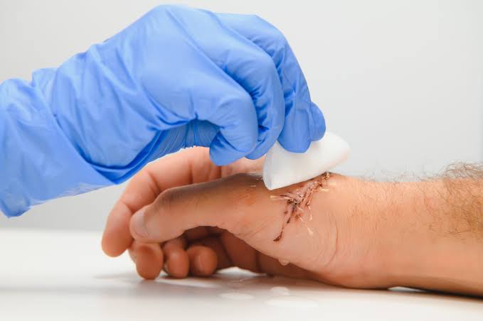 Wound Care Surgery In Nagpur